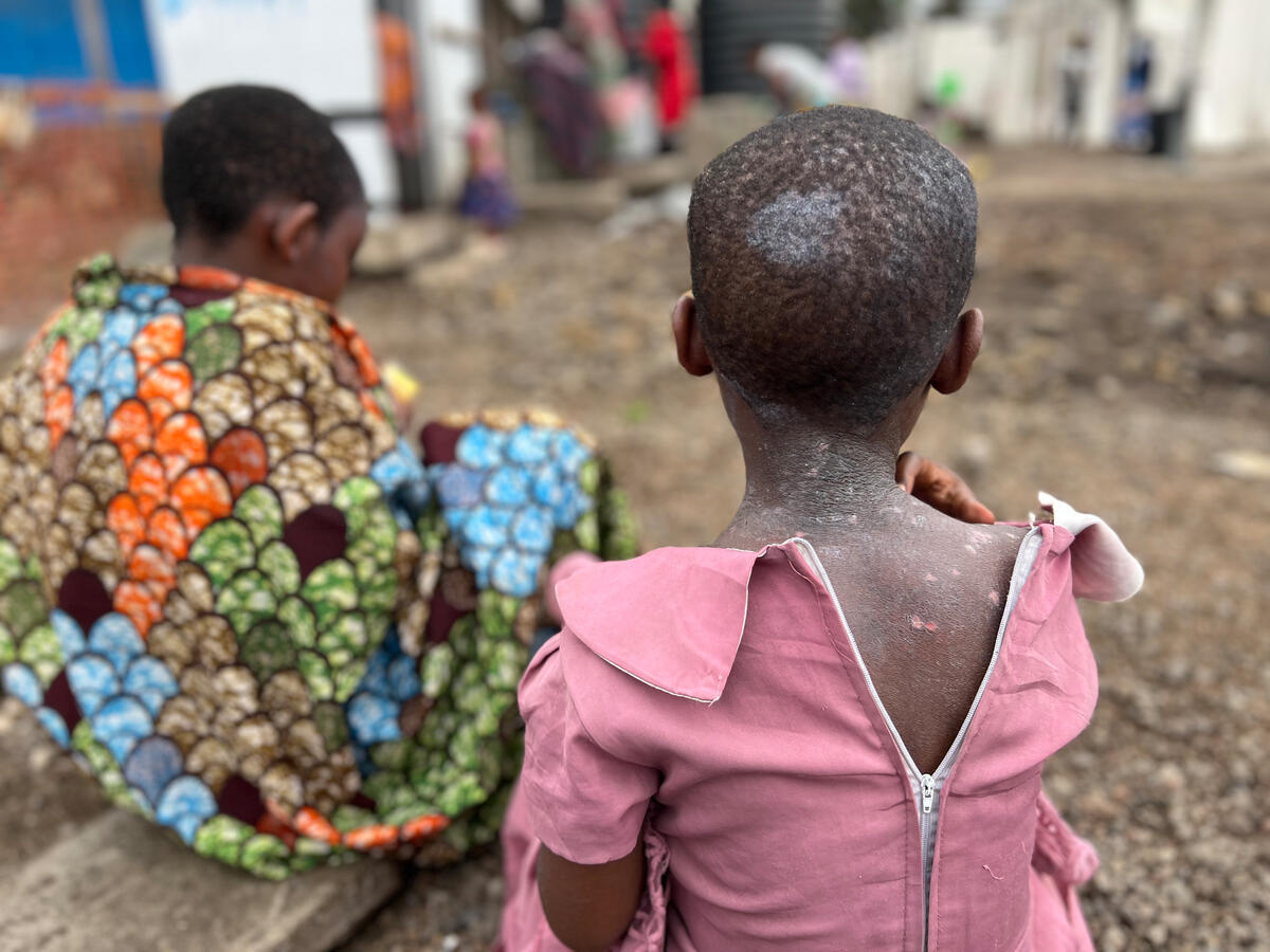 Two young girls facing away from the camera, showing mpox scars on one girls' back